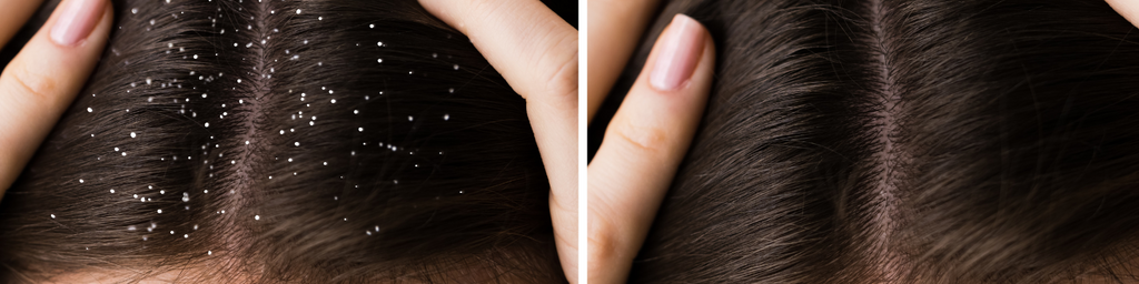Top 10 Home Remedies for Dandruff